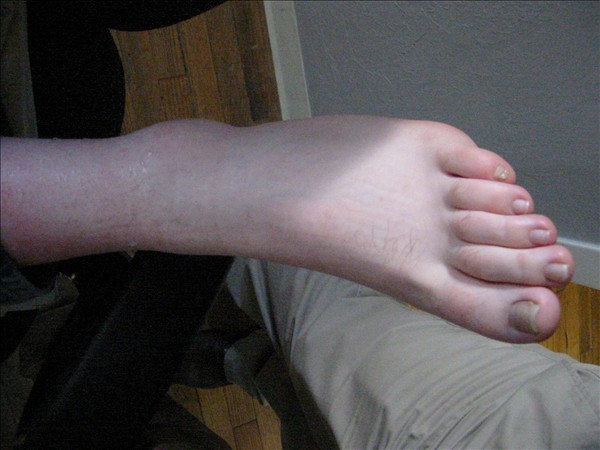 Swollen Ankle Swollen Ankle