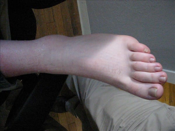 Swollen ankle 63636730 o